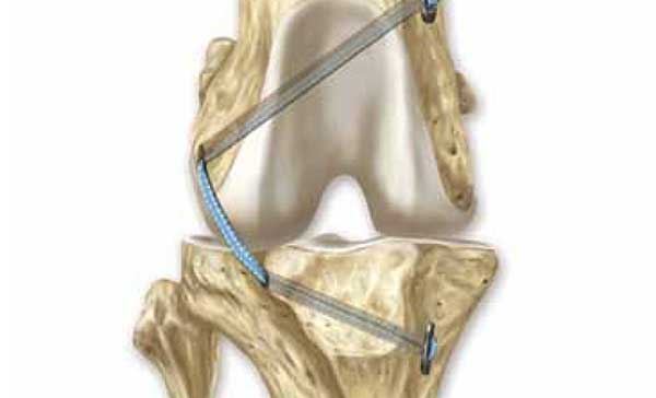 ¿Cuál es la mejor técnica quirúrgica para "reparar" el ligamento cruzado en perros? #Veterinaria.