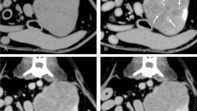 Hallazgos en la tomografía computarizada con contraste de tumores renales primarios caninos.
